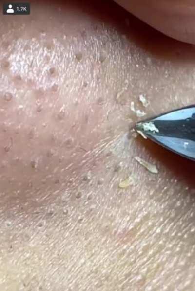 Satisfying whitehead plucks on nose