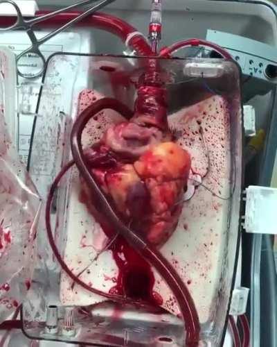 Video of a beating heart awaiting transplant!! This donor's heart is using the Organ Transplant System, Heart-in-a-Box.