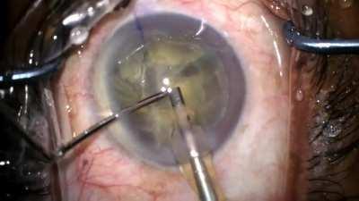 This is the cataract surgery in MrBeast's video. It's the most common cause of reversible blindness in the world