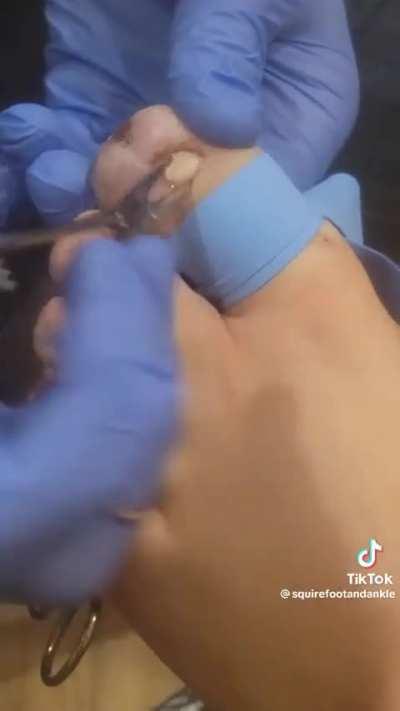 Completely buried ingrown toenail removed in one piece