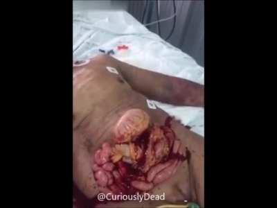 Extreme case of an abdominal wound dehiscence with possible arterial bleeding (most likely NSFL)