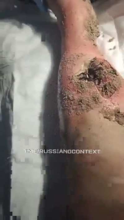 Wound of ru soldier infested with maggots