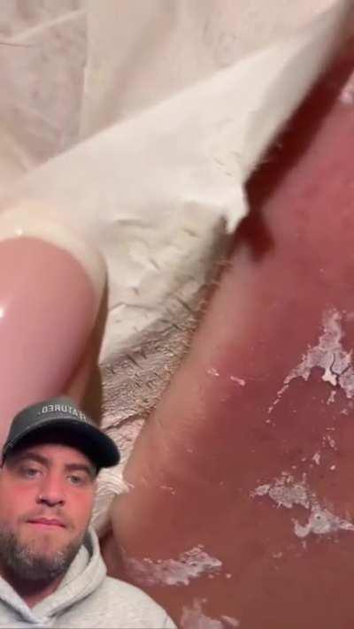 Removing many blackheads at once..