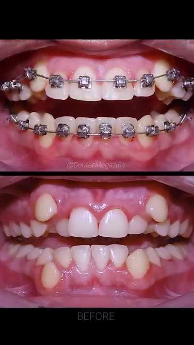 Teeth Braces Process