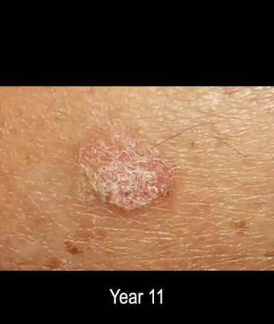 Skin Cancer Development Timelapse over 25 Years