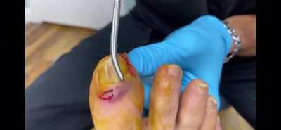 Watch as this doctor shows you the ways of removing a nail