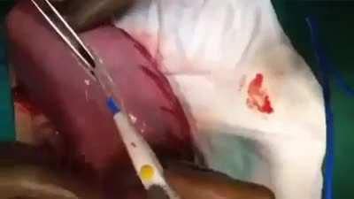 GIANT Hairball removed from woman’s stomach! This video shows the surgical removal of a trichobezoar (hairball) that formed from the ingestion of human hair.