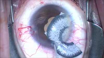 Eye surgery