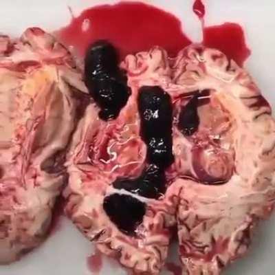 Intracerebral hemorrhage discovered during brain autopsy