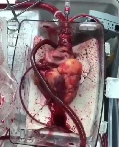 Beating heart awaiting transplant