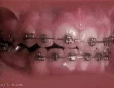 How braces work