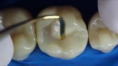 Filling In A Dental Filling Using “Composite Fillings”