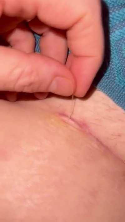 Pulling out a dissolvable stitch from surgery scar