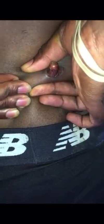 Man pushes bullet out of his own back