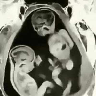 These twins fighting in their mother's womb.