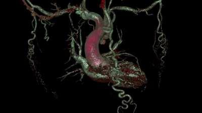 Collateral Flows in Patients with Aortic Coarctation