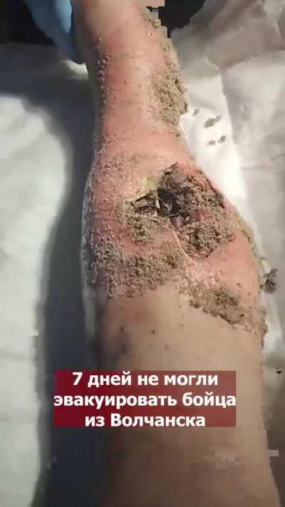 This is what the leg of an Russian soldier who waited 7 days for evacuation from Volchansk looks like