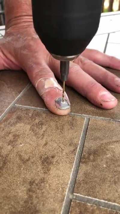 Man self drilling a hole in his nail to relieve pressure - Make me suffer a lot