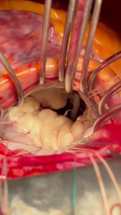 Mitral valve repair: testing mid-repair