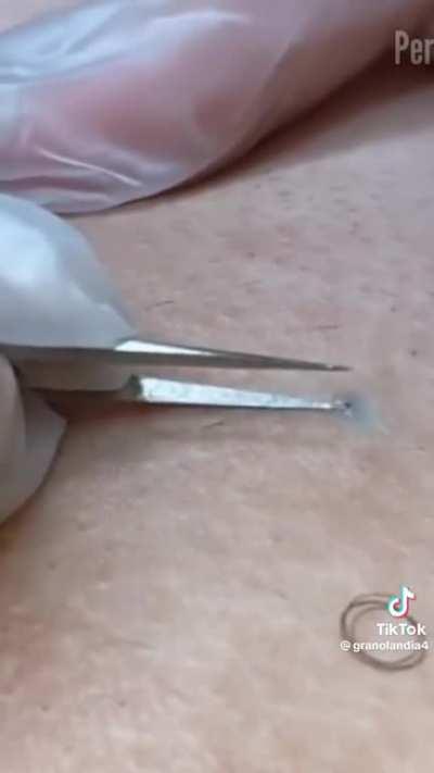 Removing an ingrown hair