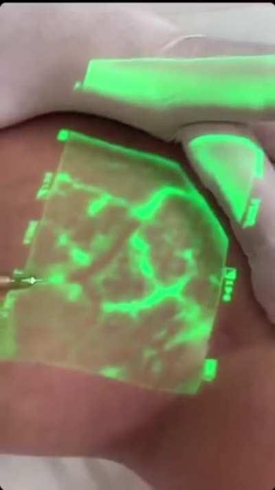 VeinViewer helping doctors find veins