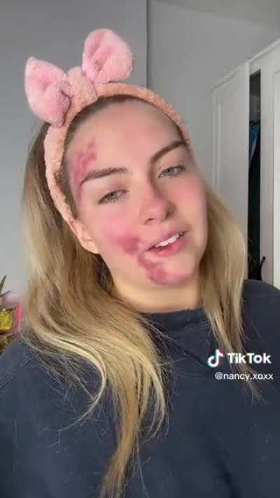 TikToker Nancy has a rare skin condition that causes random flare-ups, here is one caught on camera from the onset.