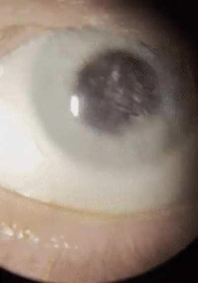 Snow globe eye. Asteroid hyalosis is a condition where people have calcium deposits floating around in the eye.