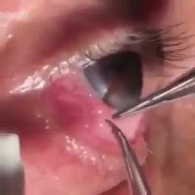 A live parasitic worm being removed from a man’s eye