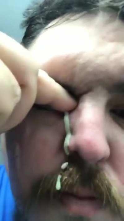 A juicy zit