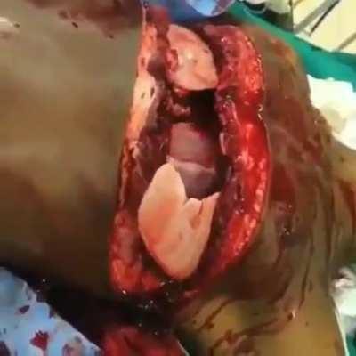 An emergency left thoracotomy due to a gunshot wound to the thorax.