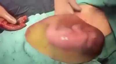 C-section, where the baby was born en-caul (in the amniotic sac)