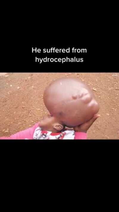 Boy Suffering From Hydrocephalus