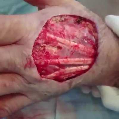 This patient underwent a surgical excision of a giant squamous cell carcinoma on the dorsum/back of his hand.⁣ The video was taken prior to a skin graft placed on the affected area!⁣