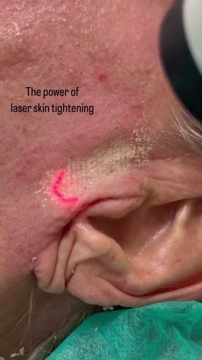 Skin tightening using fractional CO2 laser