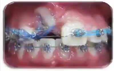 How braces straighten our teeth.