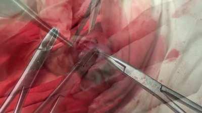 Properly Done Low & Tight Circumcision 1 - If You Are Squeamish Watching Surgery Videos Please Don't Watch