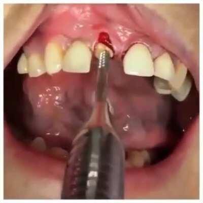 Tooth extraction