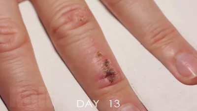 Time lapse of a wound healing