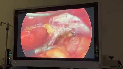 Video of mini gastric bypass 