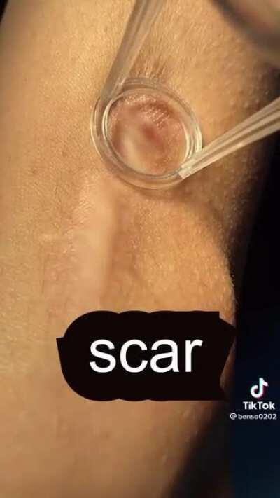 Laser scar treatment