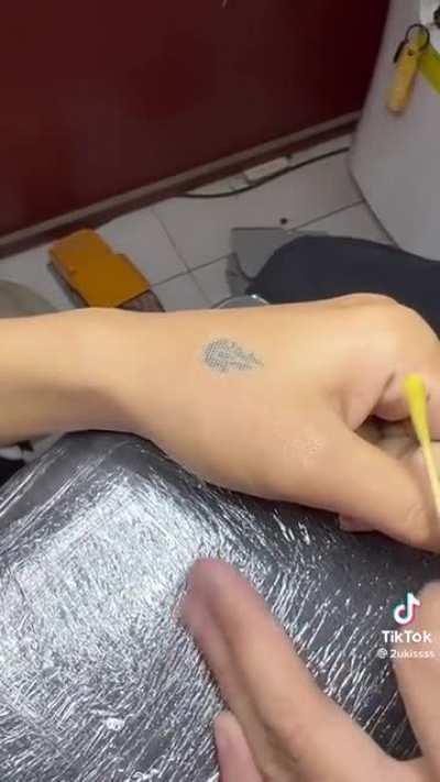 Laser tattoo removal