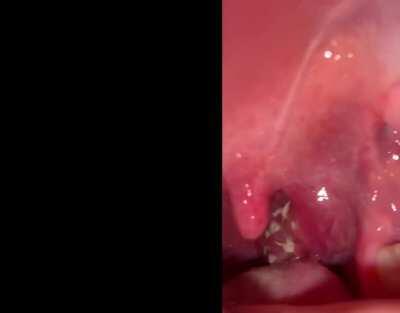 My girlfriends throat, her tonsils are infected