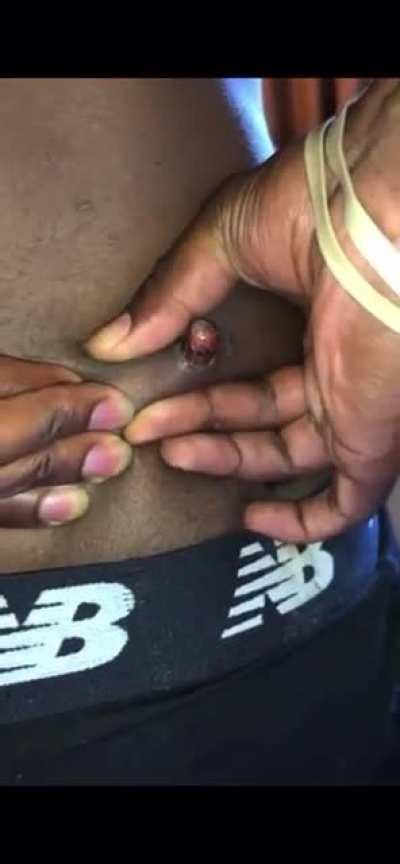 Man pushes bullet out of his own back