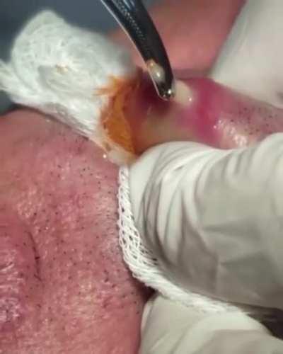 the larvae of a botfly being carefully removed from the upper lip of a man’s mouth after growing from an egg to a full size.