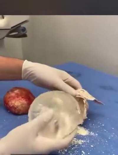 Calcification of breast implant