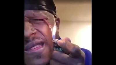 What could go wrong in putting a firecracker into your eye and lighting it