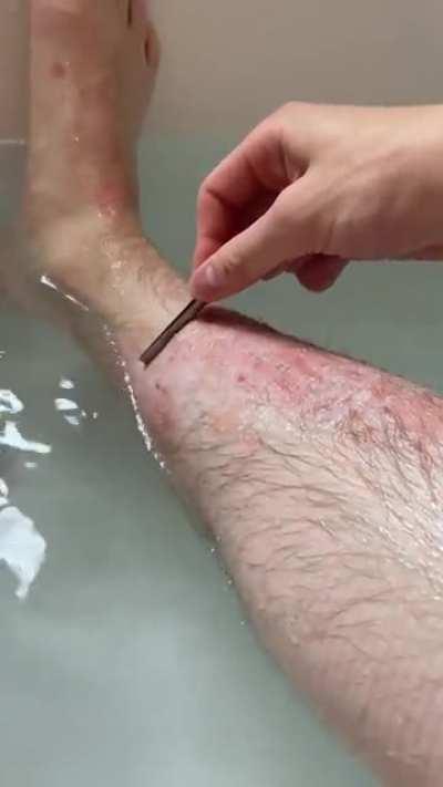 My psoriasis after a long soak in the bath