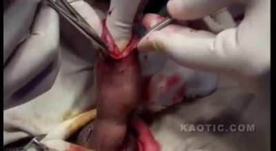 Penis Surgery