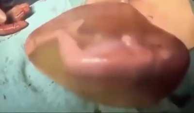 C-section baby born in amniotic sac