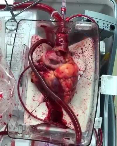 Video of a beating heart awaiting transplant!! This donor heart is using the Organ Transplant System, Heart-in-a-Box.